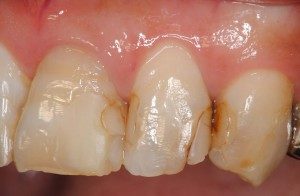 白い詰め物 レジン充填 長く持つ治療と持たない治療の違いは 市原市五井の歯医者なら つねいずみ歯科医院
